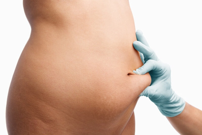 Cirurgia plastica de abdomen