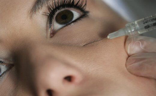mulher fazendo preenchimento de olheiras com ácido hialurônico