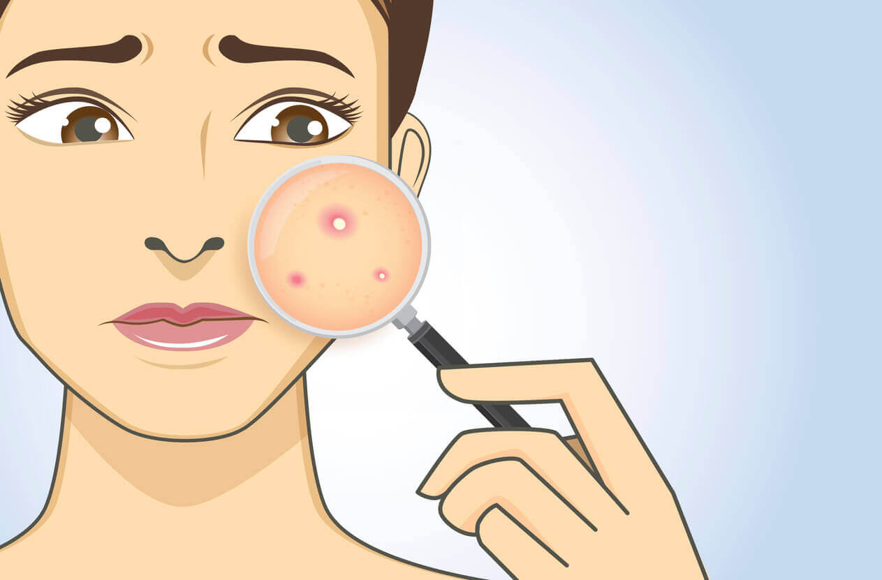 O que pode gerar acne em adultos?