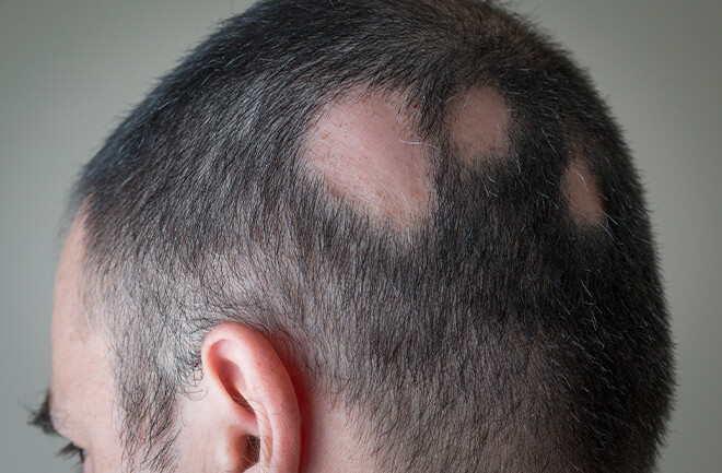 foto mostrando exemplo de alopecia cicatricial