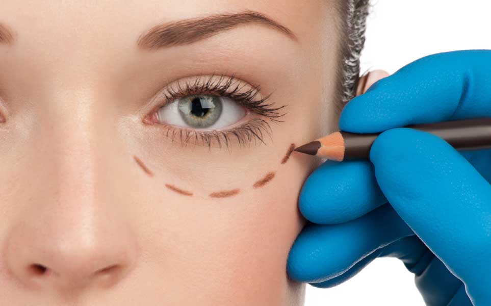 parte do rosto de uma mulher com linha tracejada abaixo do olho antes de uma Blefaroplastia