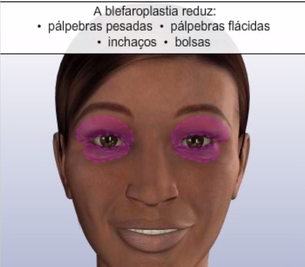 A Blerafoplastia reduz pálpebras pesadas, flácidas, inchaços e bolsas