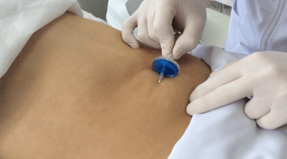 mãos de médica com luvas aplicando uma injeção de carboxiterapia