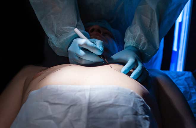 médico realizando cirurgia de ginecomastia em homem 