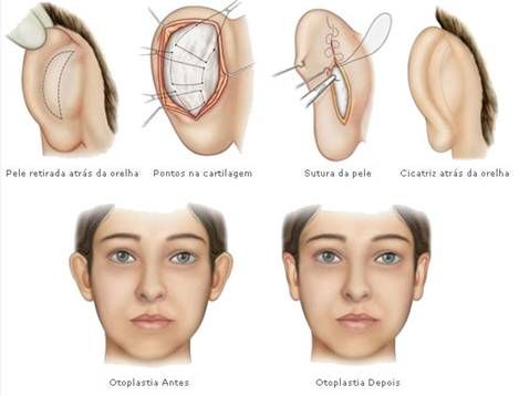 representação das incisões da cirurgia de orelha de abano