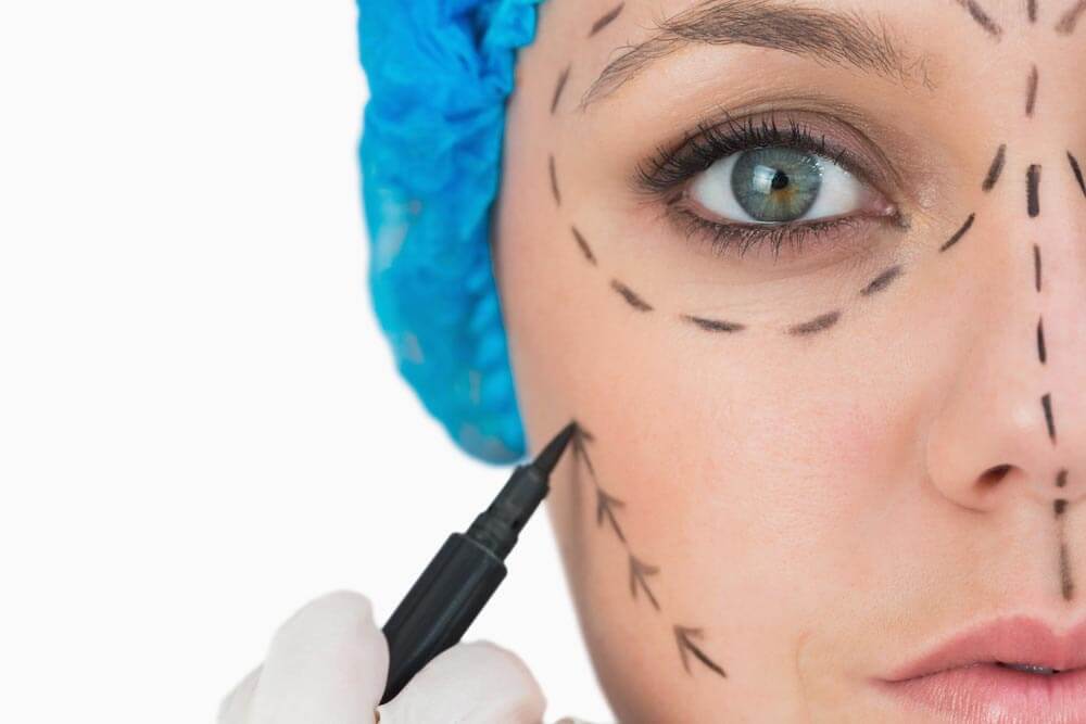 rosto de uma mulher com linhas tracejadas antes de cirurgias plásticas