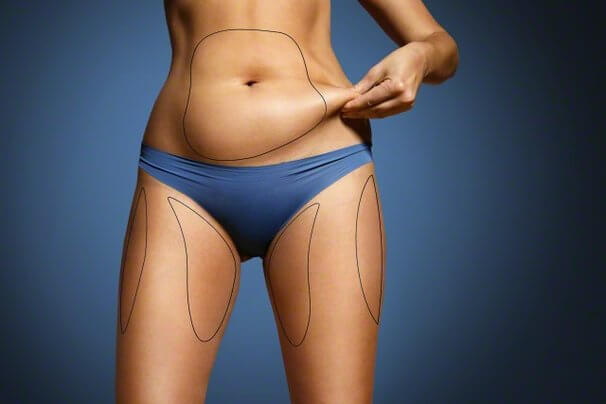 barriga e pernas de uma mulher, segurando o excesso de gordura na barriga mostrando marcações para uma cirurgia plástica