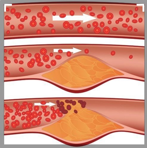 Imagem de 3 artérias. Na primeira o sangue flui normalmente. Na segunda a aterosclerose começa a entupir a veia e na terceira já há um problema maior. 