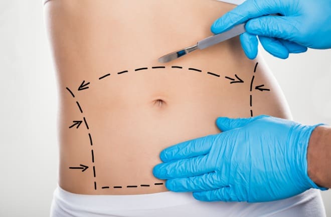 mulher realizando abdominoplastia para flacidez no abdômen