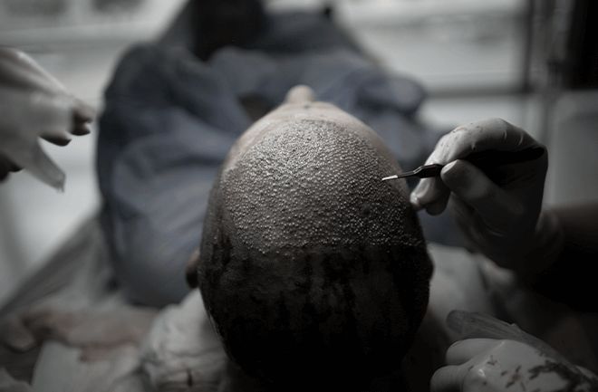 homem realizando enxerto de cabelo em mesa de cirurgia