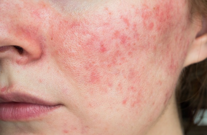 mulher sofrendo com fases da acne
