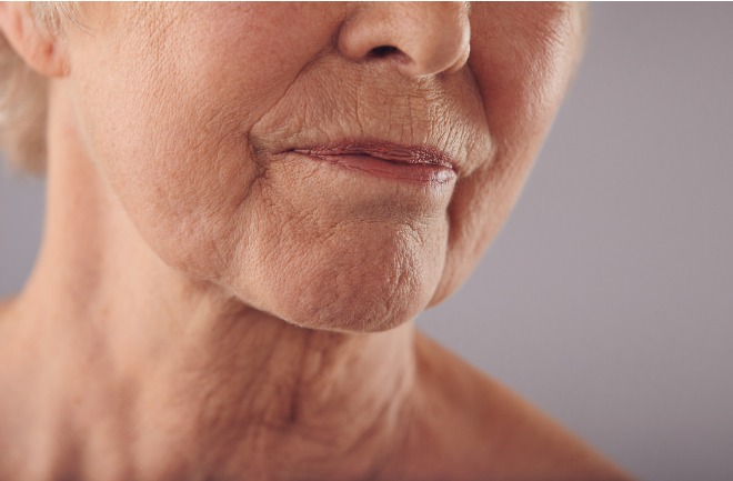 mulher com flacidez facial aparente

