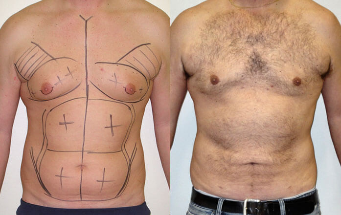 Homem com as marcações para um ginecomastia e depois da cirurgia com o resultado