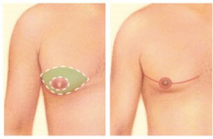 ilustração do antes e depois de um ginecoplastia