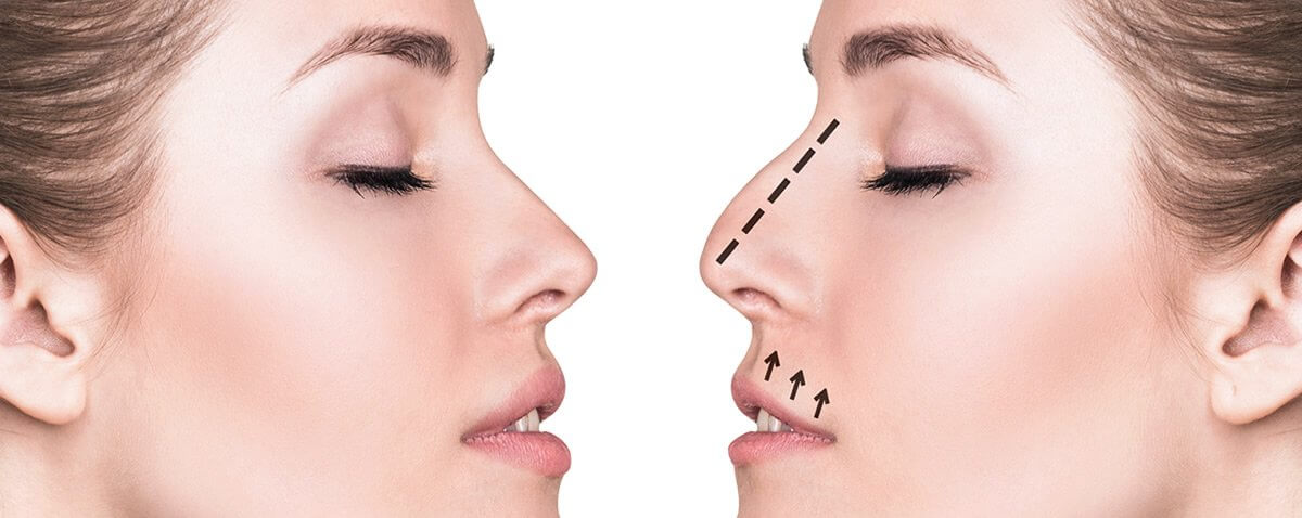 Cirurgia no nariz para transformar sua vida e sua autoestima
