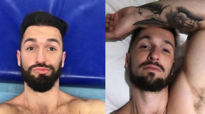 Antes e depois da harmonização facial em Diego Hypólito
