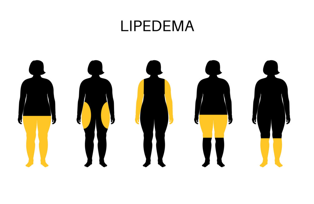 Lipedema é considerada uma doença crônica e afeta principalmente mulheres