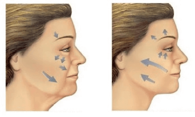 ilustração para demonstrar o lifting facial