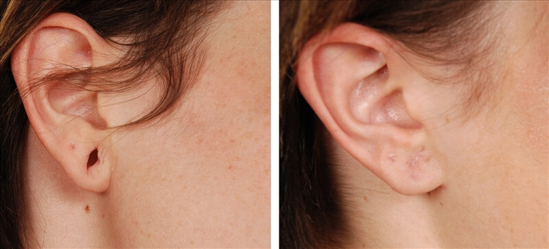 orelha antes e depois de uma lobuloplastia