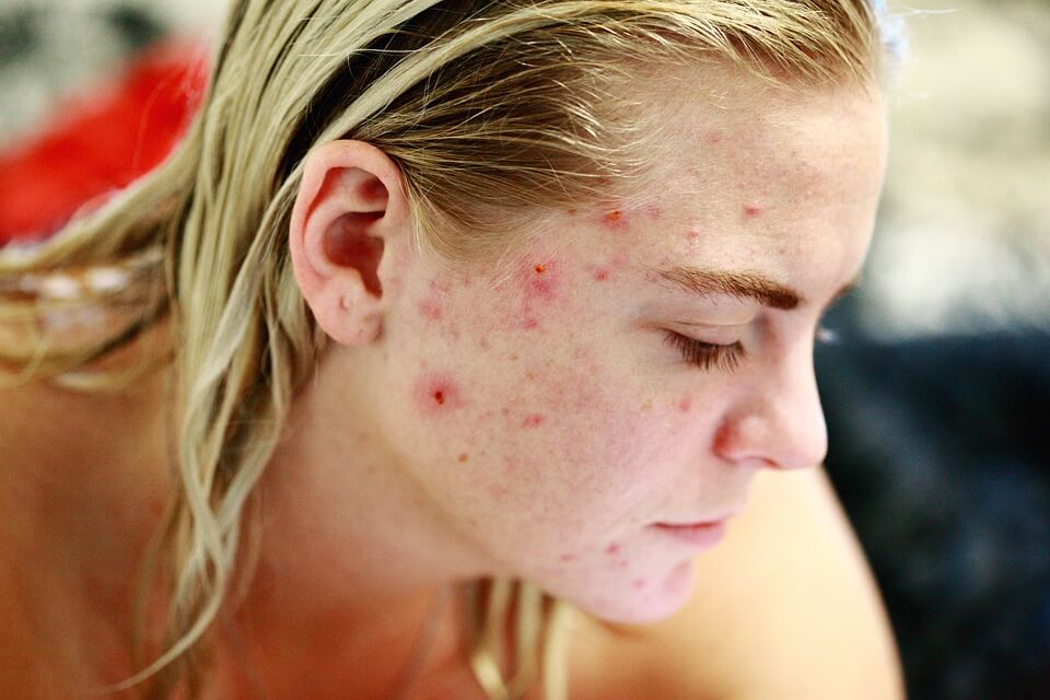 manchas de acne em rosto de mulher de perfil