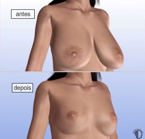 mamoplastia-redutora-resultados