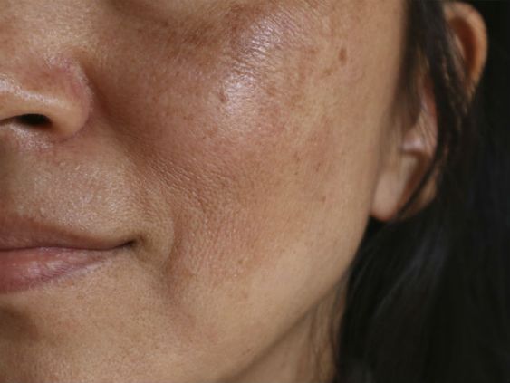 A imagem mostra parte de um rosto feminino, com manchas na pele