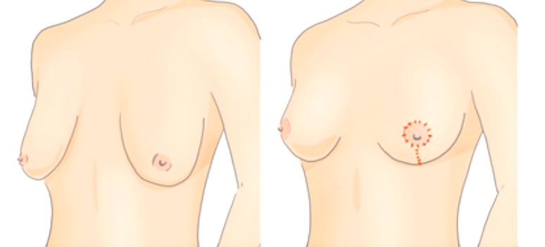 ilustração de seios antes e depois de mastopexia