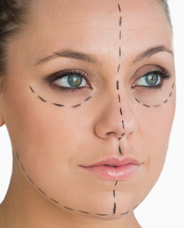 mulher com marcações de cirurgia plástica no rosto