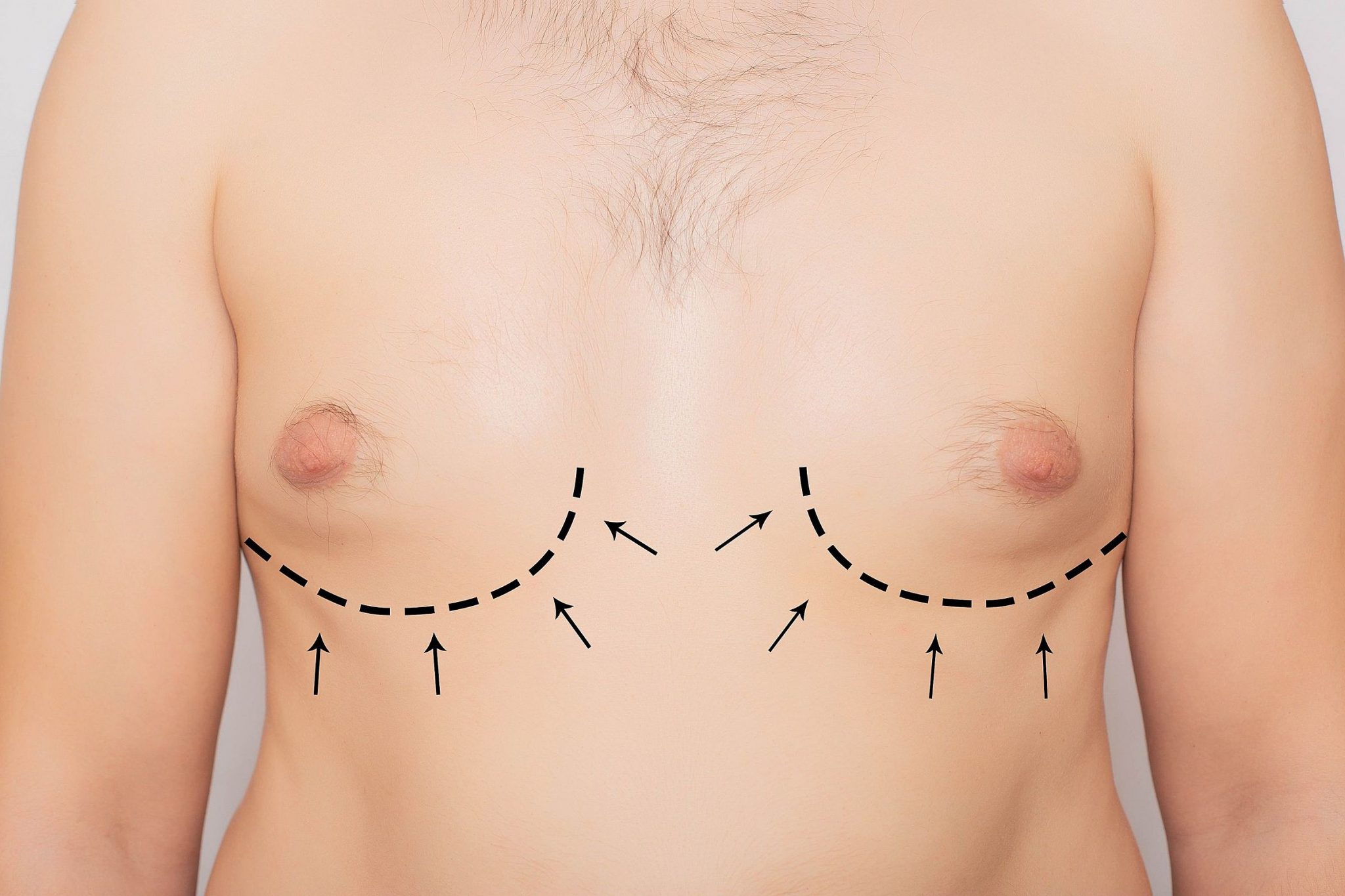 mamoplastia redutora em homens