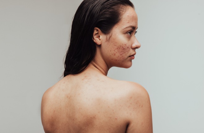 mulher candidata a procedimentos para acne com marcas pelo rosto