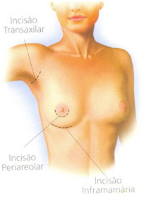 Como funciona a cirurgia de prótese de mama?