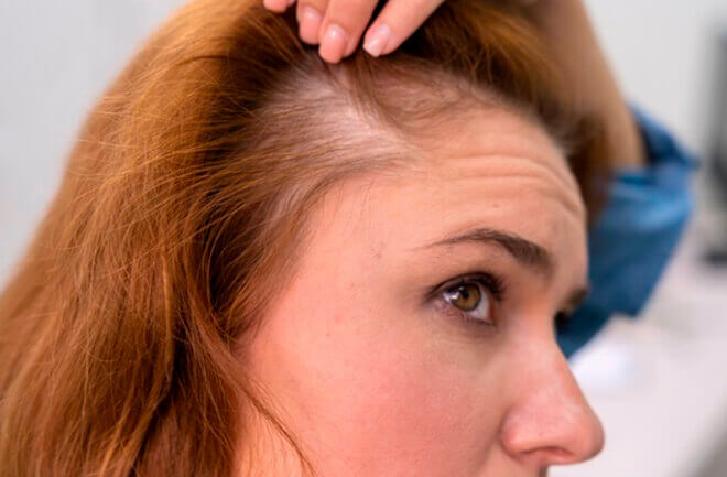 mulher preocupada com queda de cabelo após bariátrica