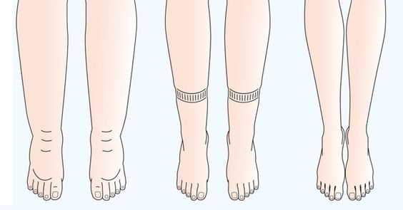 representação da retenção de líquido e inchaço nas pernas