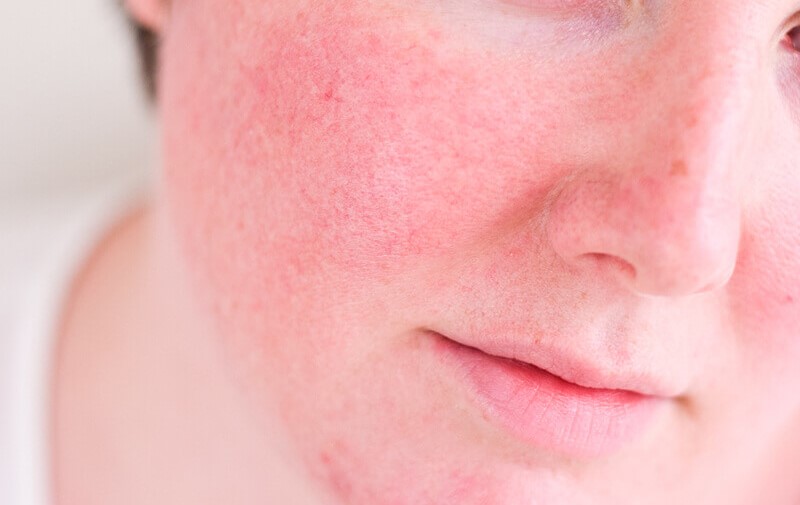 Mulher de pele branca apresentando vermelhidão, uma doença chamada Rosacea