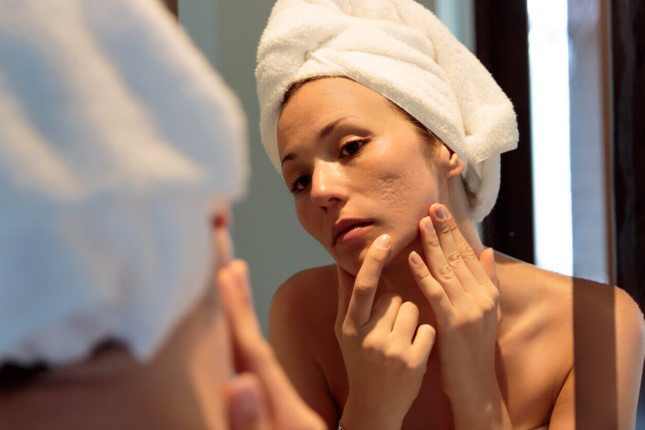 Como combater as manchas de acne?