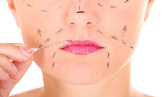 marcações no rosto de uma mulher para preenchimento facial